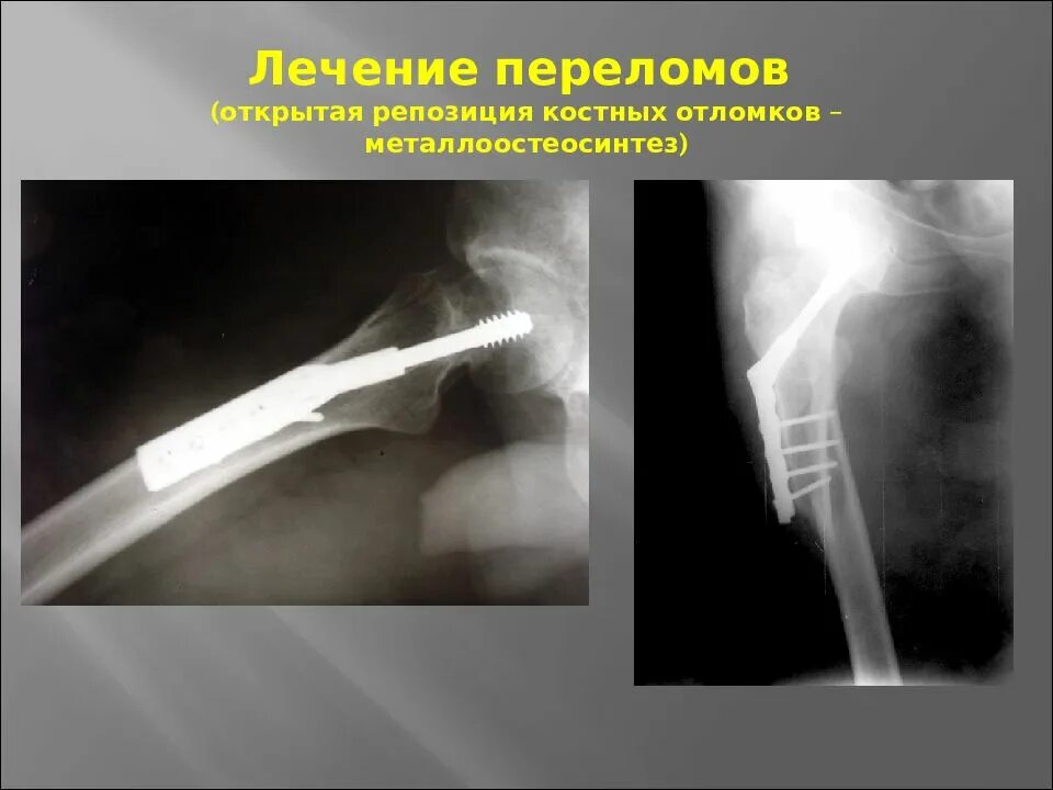 Открытая репозиция перелома. Закрытая и открытая репозиция отломков костей. Открытая репозиция остеосинтез. Открытая репозиция металлоостеосинтез. Оперативное лечение перелома костей