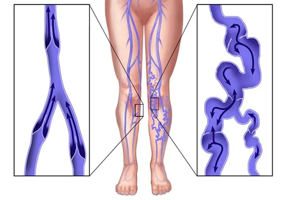 Варикозное расширение БПВ что это. Варикозное заболевания расширение вен нижних конечностей. Варикозное расширение вен малого таза. Вены ног клапаны
