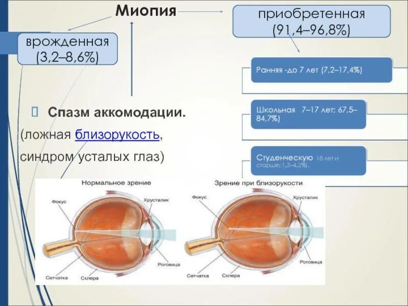 Зрение миопия. Миопия глазное яблоко. Ложная близорукость. Ложная миопия. Слабая миопия глаза что