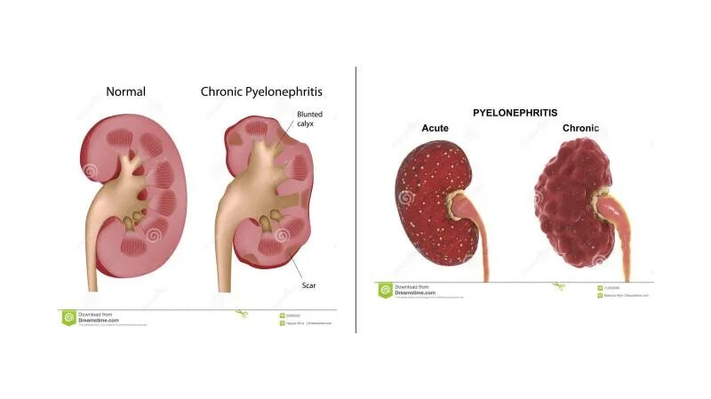Острый гематогенный Гнойный пиелонефрит. Гидронефроз и пиелонефрит. Односторонний хронический пиелонефрит. Острый серозный пиелонефрит клиника.