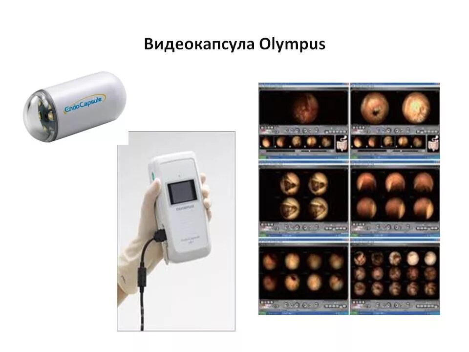видеокапсула для обследования кишечника. видеокапсула для обследования кишечника. видеокапсульная эндоскопия. видеокапсульная энтероскопия. капсульная эндоскопия кишечника.