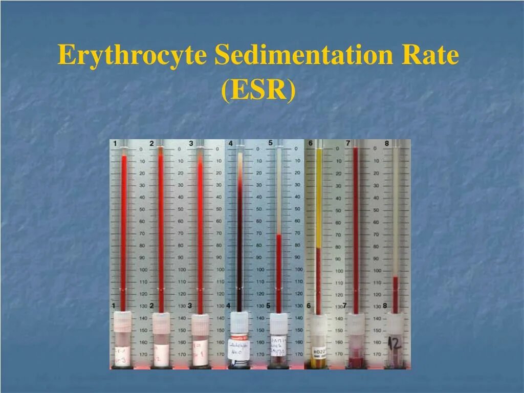 Соэ по вестергрену повышены. СОЭ. Erythrocyte sedimentation rate. СОЭ (ESR). Метод Вестергрена СОЭ.