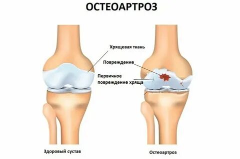 Как лечить коленный артроз 2 степени