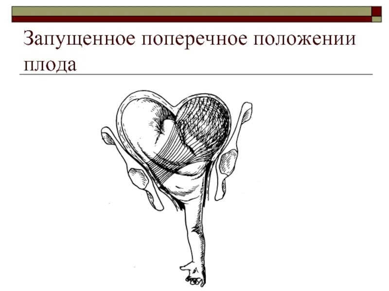 Беременность в поперечном положении