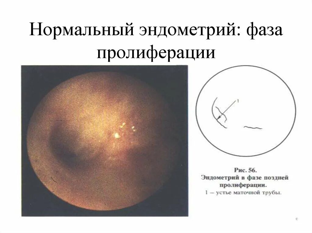 Поздняя стадия эндометрия. Эндометрий фазы пролиферации. Поздняя стадия фазы пролиферации. Эндометрия поздней стадии фазы пролиферации что это. Эндометрий фазы пролиферации гистология.