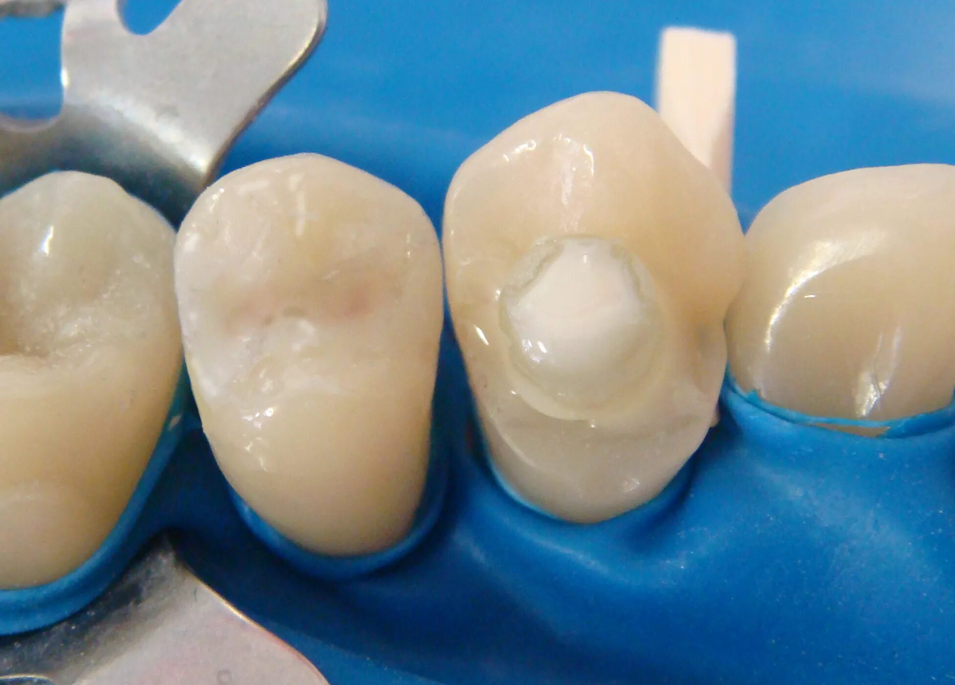 фиксация коронки штифтом. культевая вкладка штифт зуб. культевая штифтовая коронка. стекловолоконный штифт билдап. фиксация коронки штифтом.