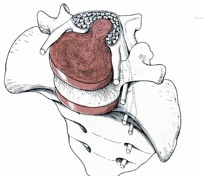 медиально парамедиальная грыжа диска. фораминальная экструзия диска l4-l5. задняя правосторонняя парамедианная грыжа диска l5-s1. циркулярное выбухание диска l4/l5. задняя медианная грыжа диска.