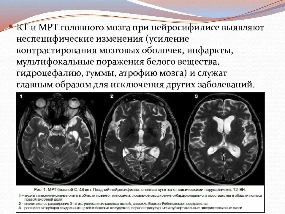 Многоочаговые поражения головного. Мультифокальное поражение головного мозга мрт. Кт головного мозга при сифилисе. Нейросифилис Гумма головного мозга. Нейросифилис по мрт головного мозга.