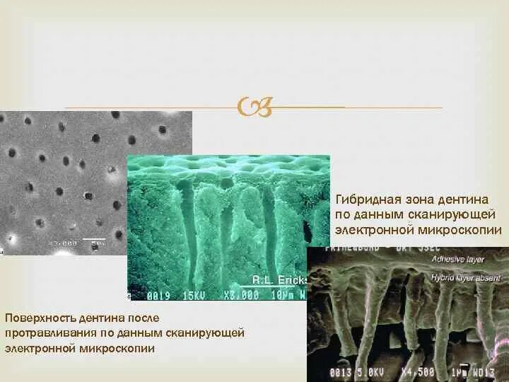 Смазанный слой в стоматологии. Гибридная зона в стоматологии это. Гибридная зона в стоматологии это. Гибридная зона. Смазанный слой в стоматологии.