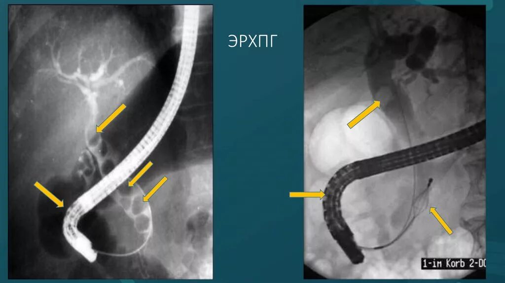 Ретроградная панкреатохолангиография. Эндоскопическая ретроградная панкреатохолангиография (ЭРХПГ. Стент желчного протока