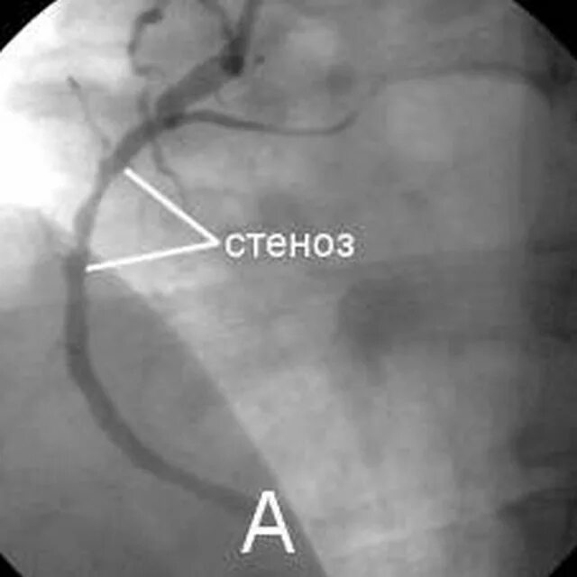 Процент стеноза сосудов. Коронарография стеноз ПМЖВ. Проксимальный стеноз ПМЖВ. Стеноз проксимального сегмента ов. Коронарография стеноз ПКА.