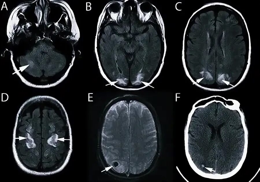 Резидуальное поражение головного. Резидуальная энцефалопатия мрт. Перивентрикулярная энцефалопатия. Резидуальная энцефалопатия у детей мрт. Перивентрикулярный очаг.