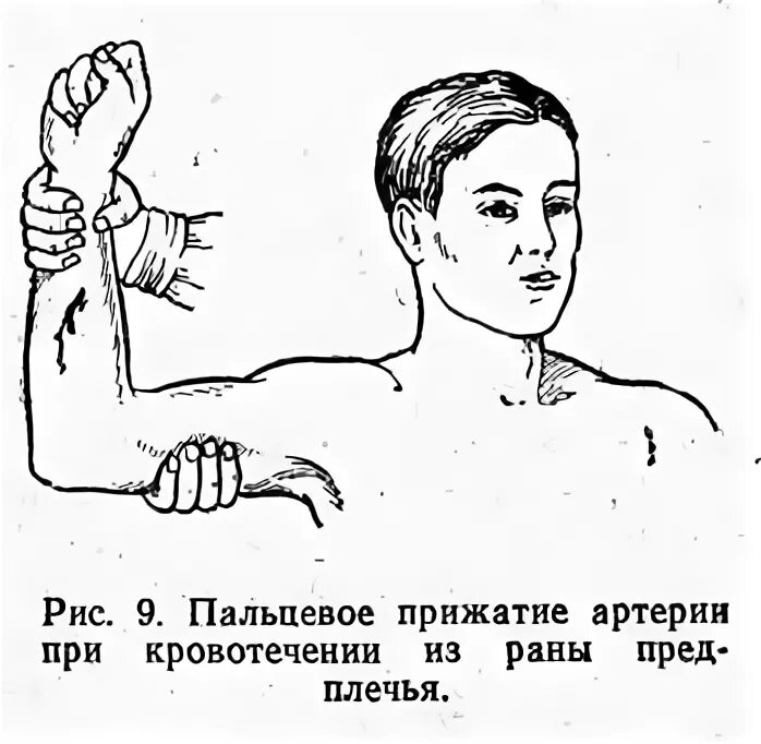 Пальцевое прижатие плечевой артерии. Остановка кровотечения способом пальцевого прижатия. Прижатие плечевой при кровотечении. Кровотечение метод пальцевого прижатия.