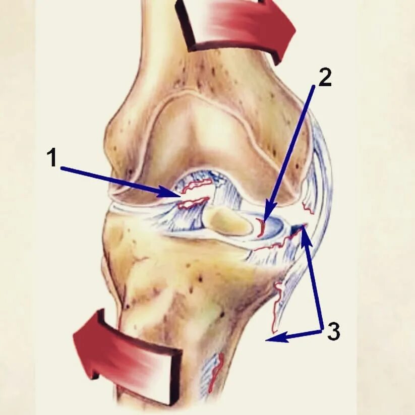 Травма связок сустава. Разрыв связок ПКС коленного сустава. Крестообразные связки коленного сустава и мениск травмы. Передние крестовидные связки коленного сустава. Травма связок, мениска коленного сустава.