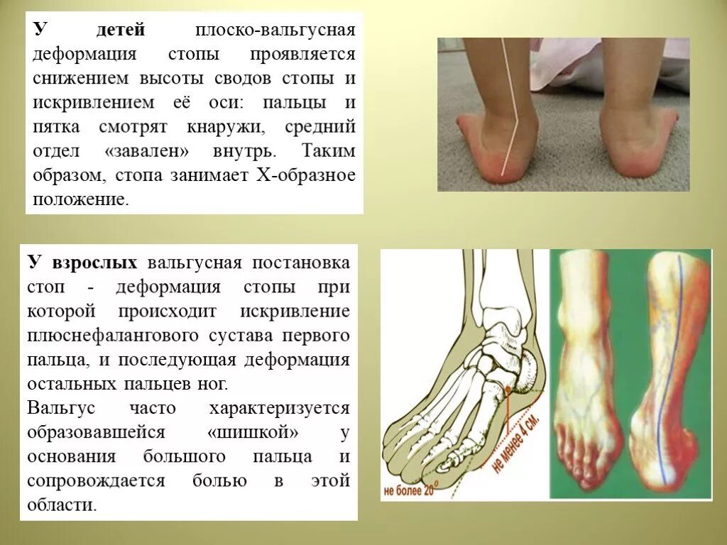 Пятки внутрь. Плоско вальгусная деформация пальцев стопы. Плоско-вальгусная деформация стоп 2 степени у детей. Плоскостопие плоско вальгусная деформация стоп ребенка. Вальгус стопы это плоскостопие.