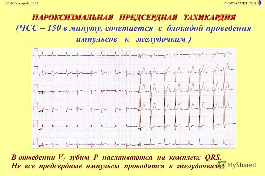 Предсердная блокада. Наджелудочковая тахикардия с АВ блокадой 2 степени. Предсердная тахикардия с АВ блокадой 2:1. Предсердная тахикардия с АВ блокадой. Предсердная пароксизмальная тахикардия на ЭКГ.