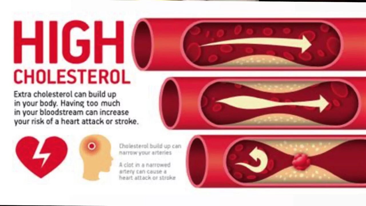 Инсульт холестерин. High cholesterol. Холестерин сердце Эстетика.