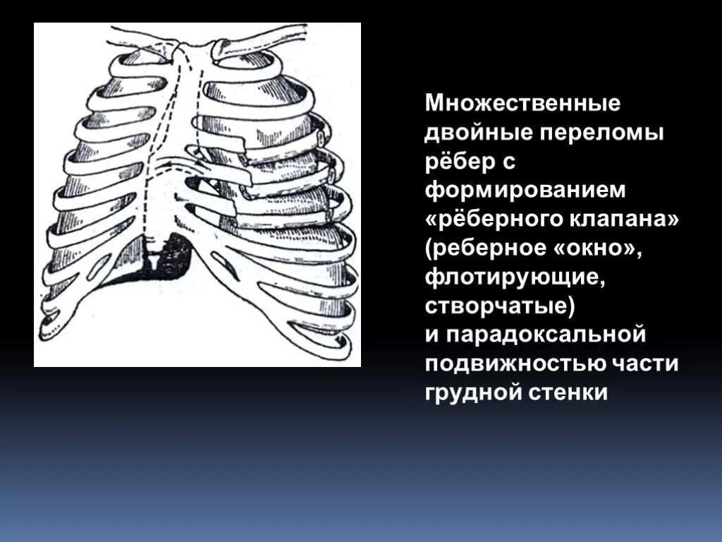 Реберный клапан при травме грудной клетки. Реберный клапан флотирующий перелом. Флотирующий перелом ребер рентген. Окончатый перелом ребер.