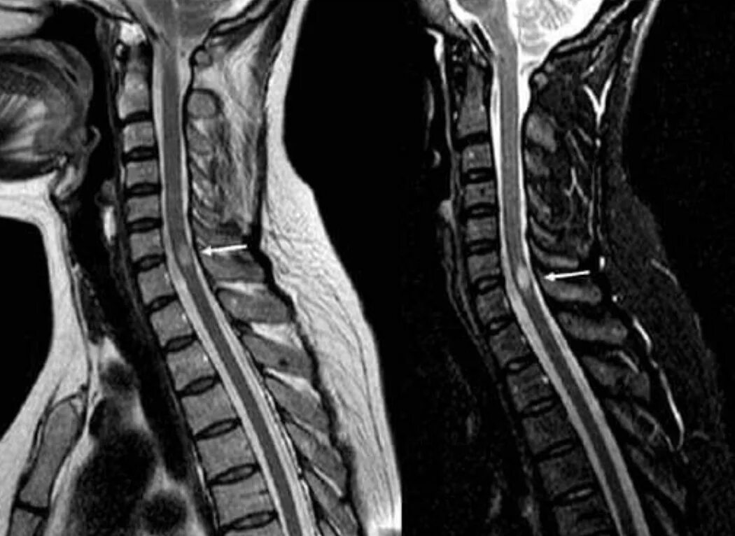 Поперечный миелит мрт. Миелит спинного мозга. Острый поперечный миелит мрт. Острый поперечный миелит спинного мозга мрт. Интрамедуллярные опухоли спинного