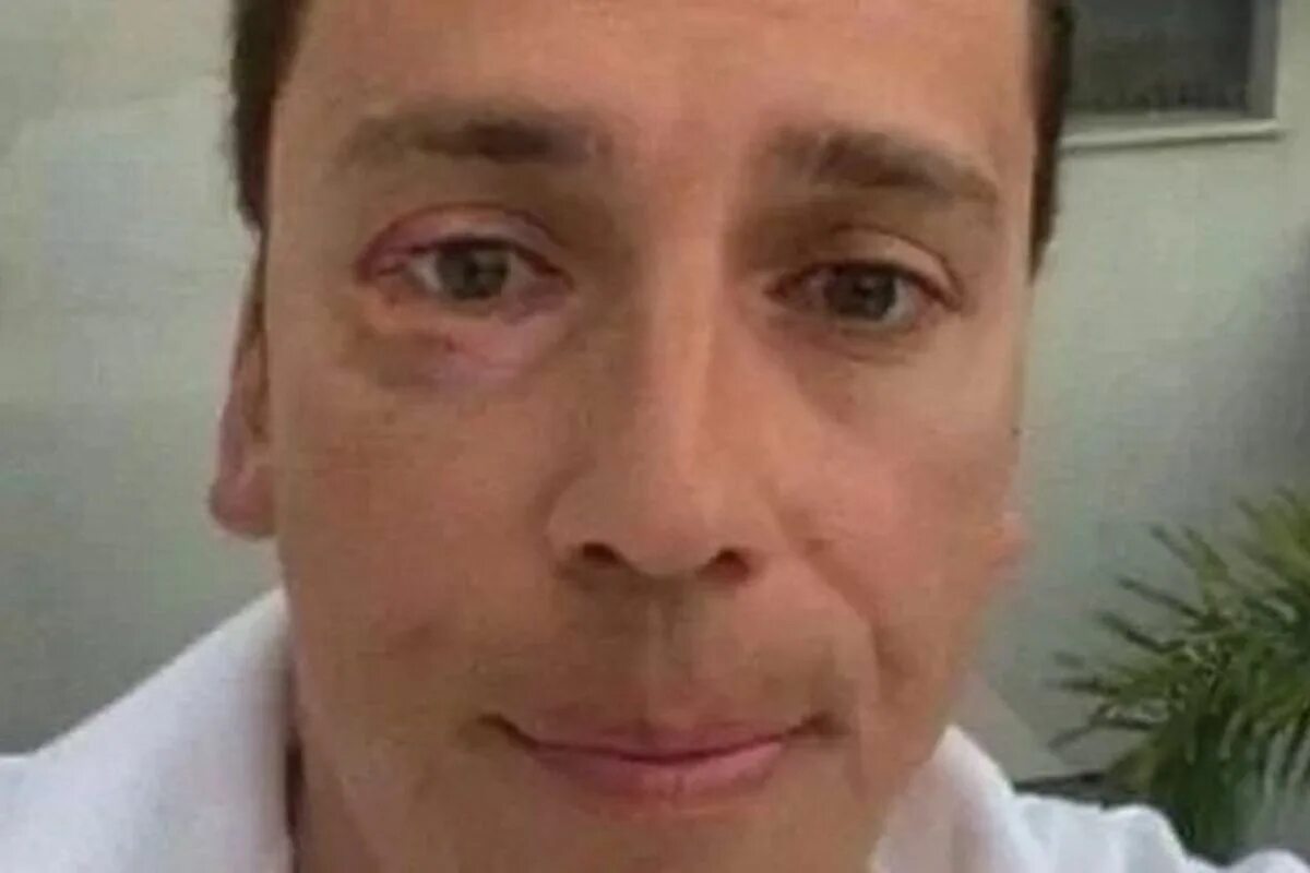 Операция ласик 3д. Дал в глаз видео. Дал в глаз видео. Дал в глаз видео. Контактные линзы надевают.