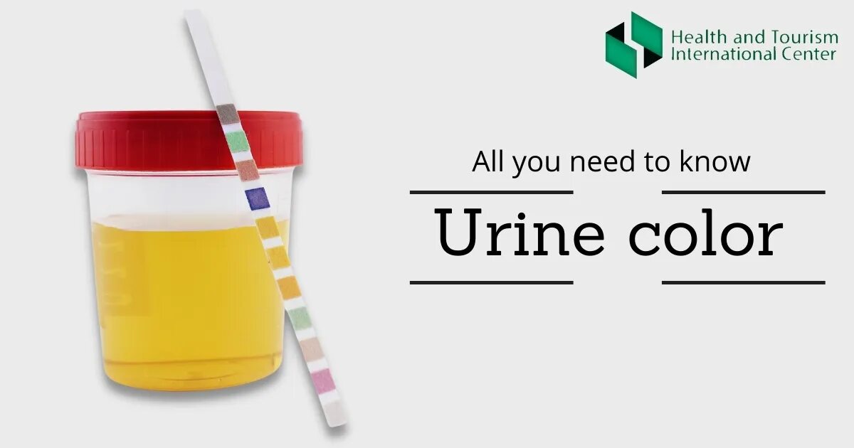 Моча цвета крепкого чая. Цвет мочи. urine color. моча цвета пива. моча цвета лайма.