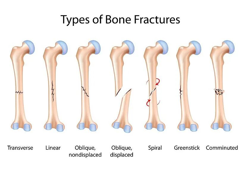 A fracture is a broken bone