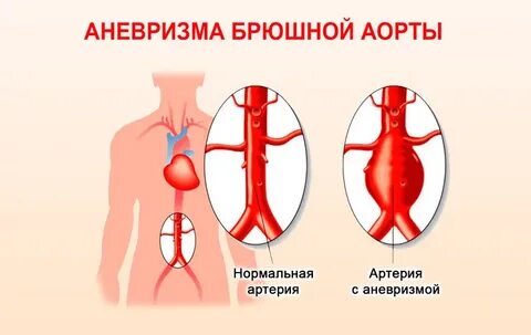 Аневризма брюшной аорты что это такое