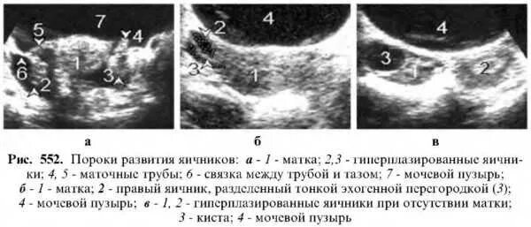 Яичники в пременопаузе. Пороки развития маточных труб. Пороки развития маточных труб и яичников. Аномалии развития яичника и маточных труб. УЗИ матки с трубами и яичниками.