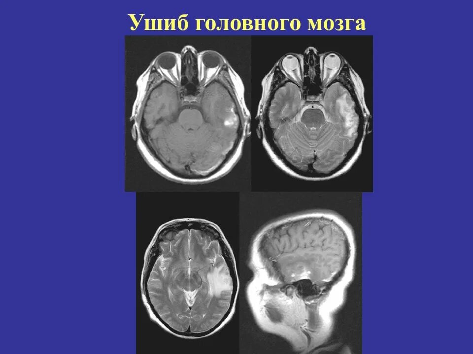 Мрт при сотрясении. Мрт сотрясение головного мозга снимок. Степень ушиба головного мозга кт диагностика. Ушиб головного мозга мрт.