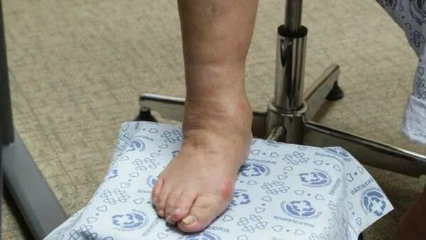 Ankle stabilization exercise, part 1 ST Medical Clinic