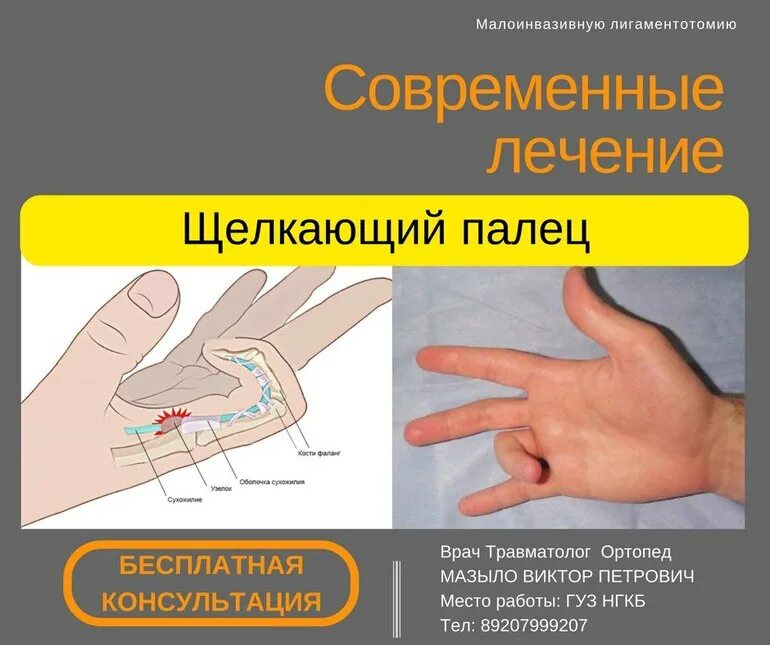 Стенозирующий лигаментит. Болезнь Нотта. Стенозирующий лигаментит пальца. Стенозирующий лигаментит большого пальца кисти. Стенозирующий лигаментит 1 пальцев кистей.