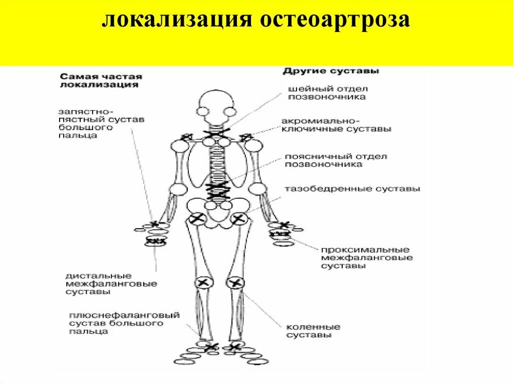 Названия суставов человека. Локализация остеоартроза. Суставной синдром презентация. Типичная локализация суставного синдрома. Локализация это.