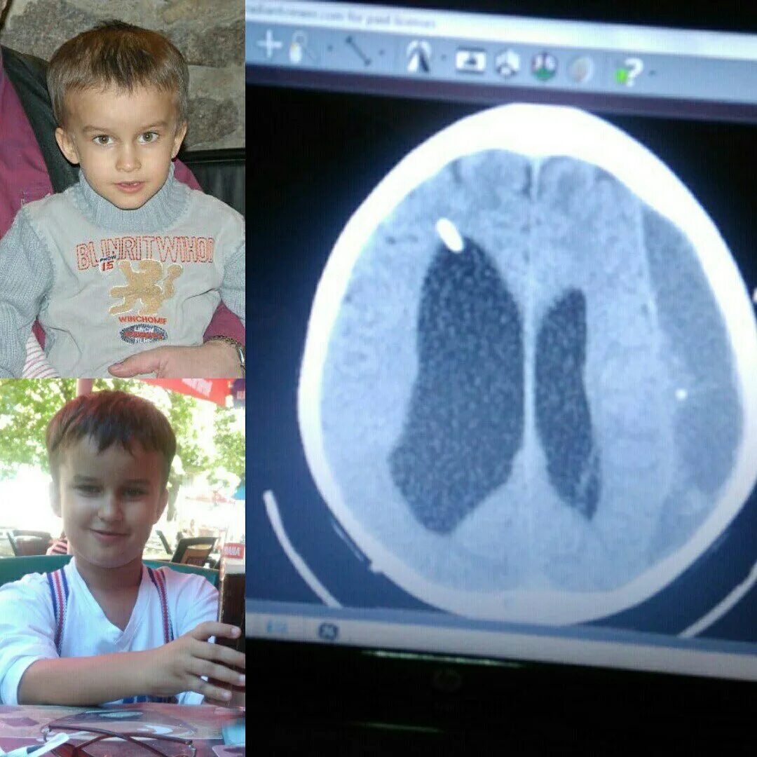 Постгеморрагическая гидроцефалия. Риногенная гидроцефалия. Водянка головного мозга у детей. Гидроцефалия головного мозга у ребенка.