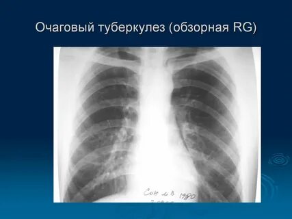 Туберкулезного спб