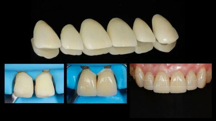 восстановление эстетики зубов. изоляция зубов фронтальных коффердам. восстановление зуба композитом. материалы для реставрации фронтальной. восстановление передних зубов.
