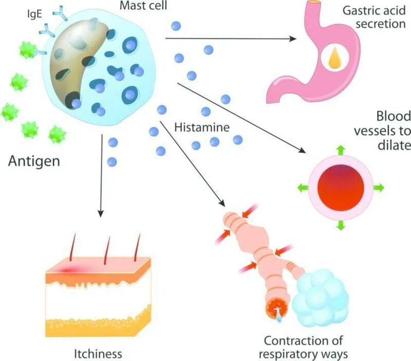 Повысить гистамин. Гистамин в аллергических реакциях. Гистамин симптомы. Непереносимость гистамина. Гистамин аллергия.
