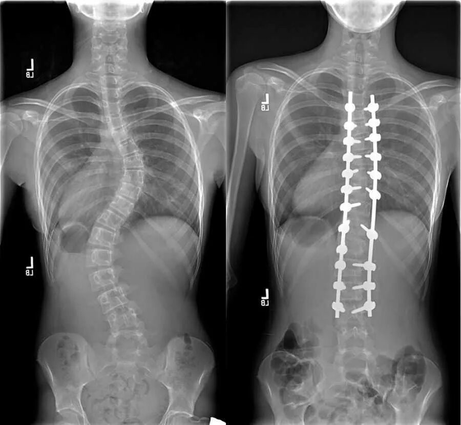 Сколиоз позвоночника операция. Идиопатический сколиоз операция. Рентген позвоночника сколиоз 1. Левосторонний сколиоз рентген. Конструкция позвоночника операция