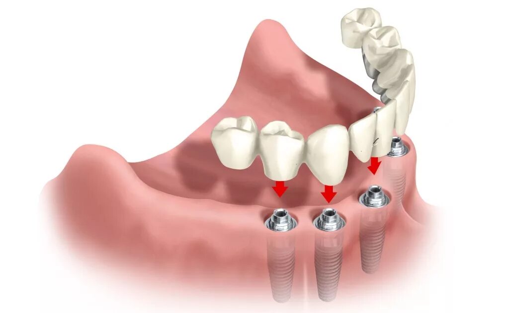 Мостовидный имплант на 4 зуба. Несъемные зубные протезы. Несъемные зубные протезы коронки. 3 зуба установить