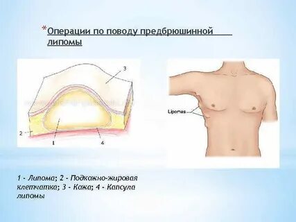 Подкожное жировое скопление