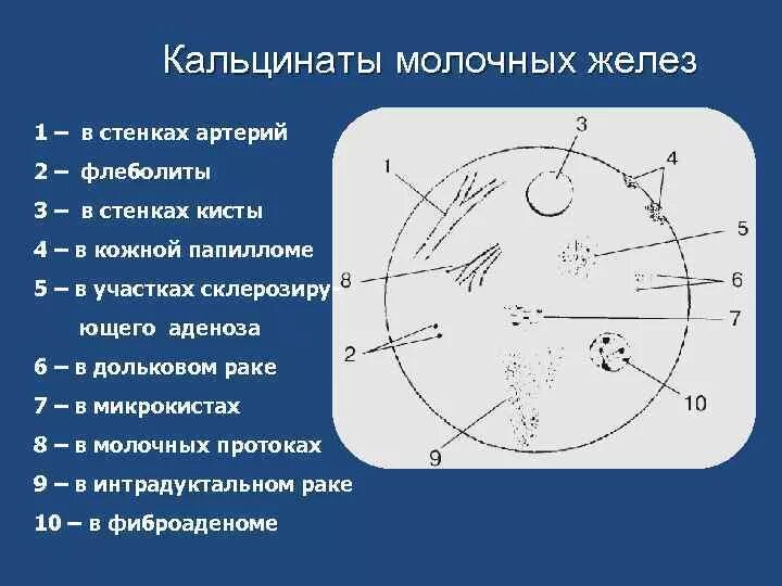 Округлые кальцинаты. Кальцинаты молочных желез. Протоковые кальцинаты в молочной железе. Квадранты молочной железы схема. Диффузные кальцинаты в молочной железе.