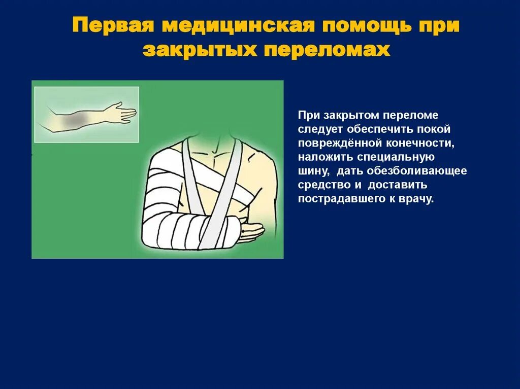 Тест травмы обж. Последовательность оказания первой медицинской помощи при переломах. Первая помощь при закрытых переломах. Первая медицинская помощь при закрытых переломах. Оказание первой помощи при закрытом переломе.