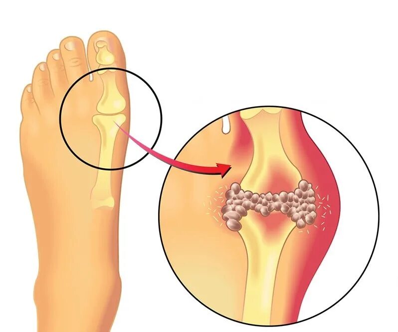 Таблетки от мочевой кислоты в суставах. Периартрическая подагра. Отложение солей мочевой кислоты. Погагра. Pelagră.