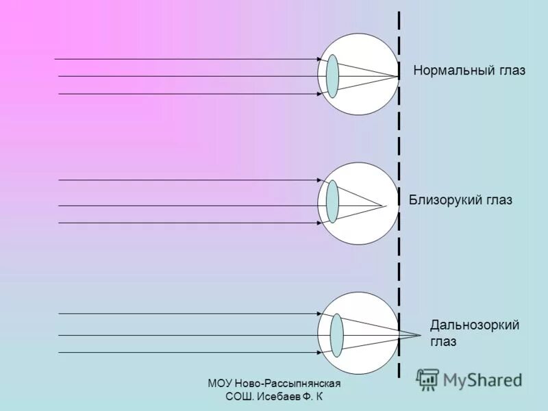 Нормальный глаз схема