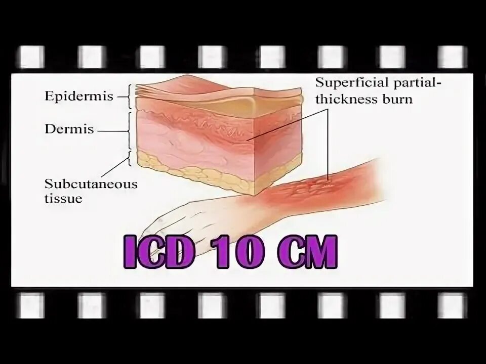 Ожог 1 степени код по мкб. Ожог код. Степень ожога пмп 4 степени. Клинические проявления термических ожогов первой степени. Мкб-10 международная классификация болезней ожогов.