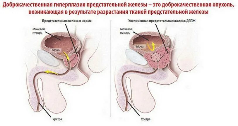 Доброкачественная гипоплазия предстательной железы. Простата гиперплазия предстательной железы. Норма ДГПЖ объем. Гиперплазия предстательной железы 1