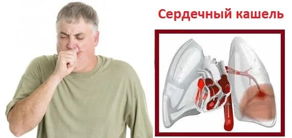 При кашле сильно болит. Сердечный кашель. Кашель при сердечной недостаточности. Кашель с кровью при сердечной недостаточности.