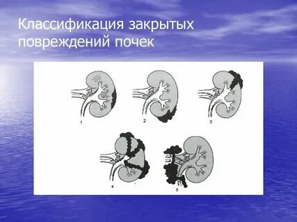 Повреждение почек