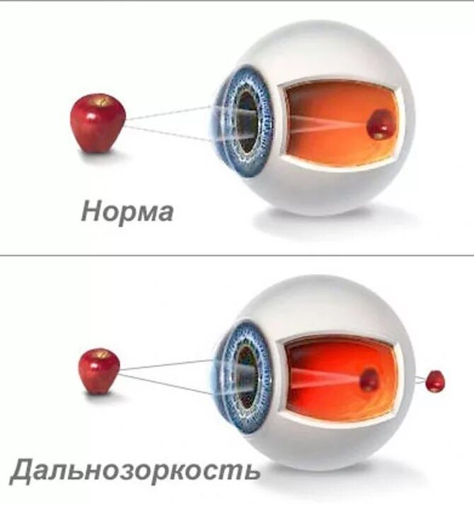 Изображение дальнозоркости