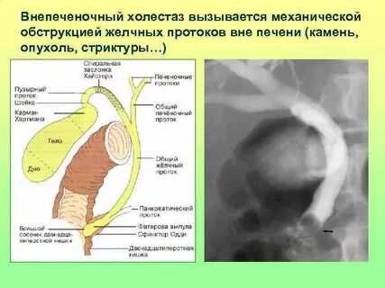 Обструкция желчевыводящих путей что это