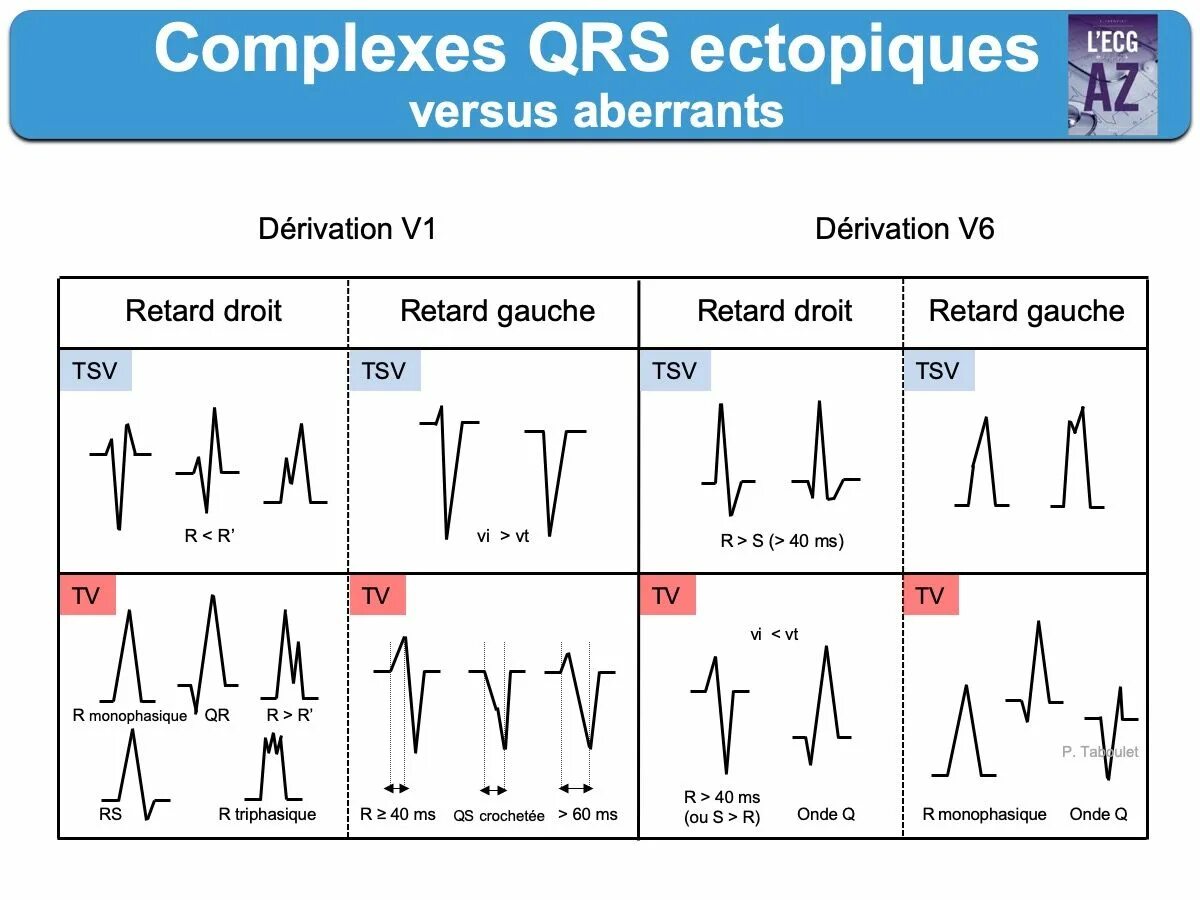 Отрицательный комплекс QRS на ЭКГ. Комплекс QRS на ЭКГ. Расширение комплекса QRS на ЭКГ. ЭКГ комплекс QRS В v2.